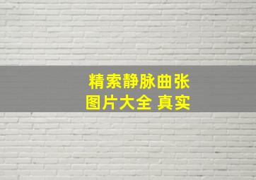 精索静脉曲张图片大全 真实